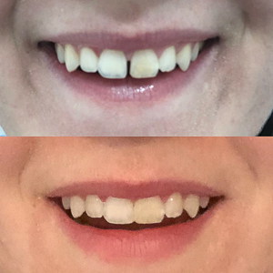 Before and after front teeth repair